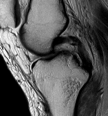 PCL Midsubstance tear with stretching